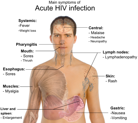 Symptoms of acute HIV infection
